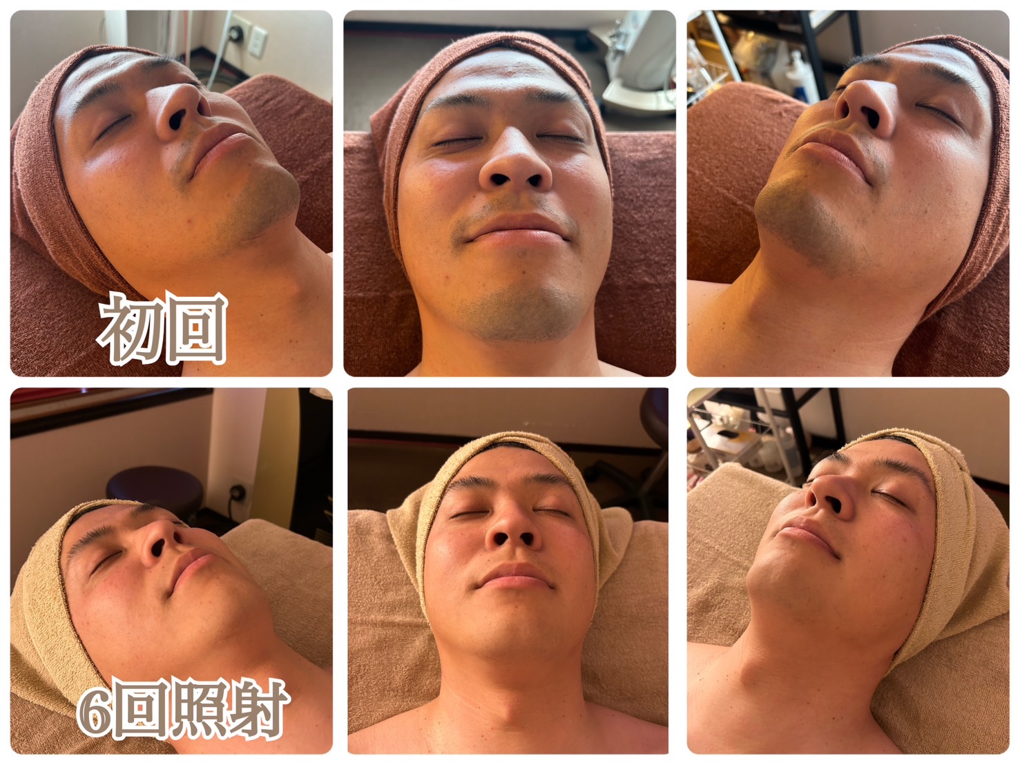 ヒゲ脱毛 初回→6回照射