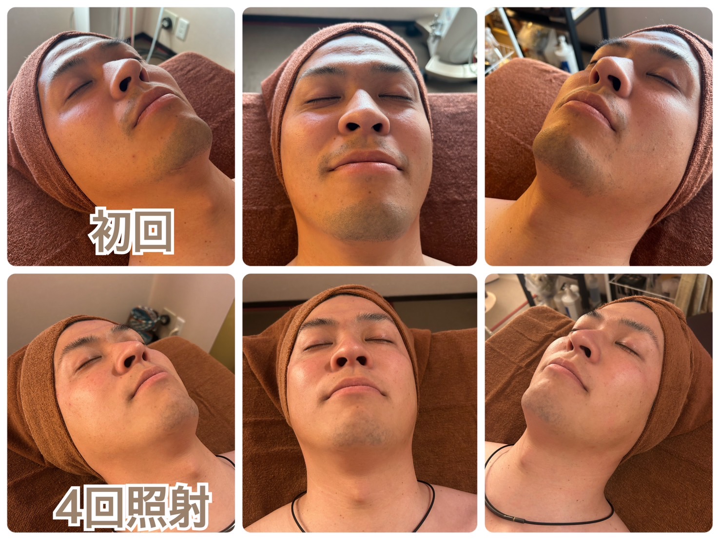 ヒゲ脱毛 初回→4回照射