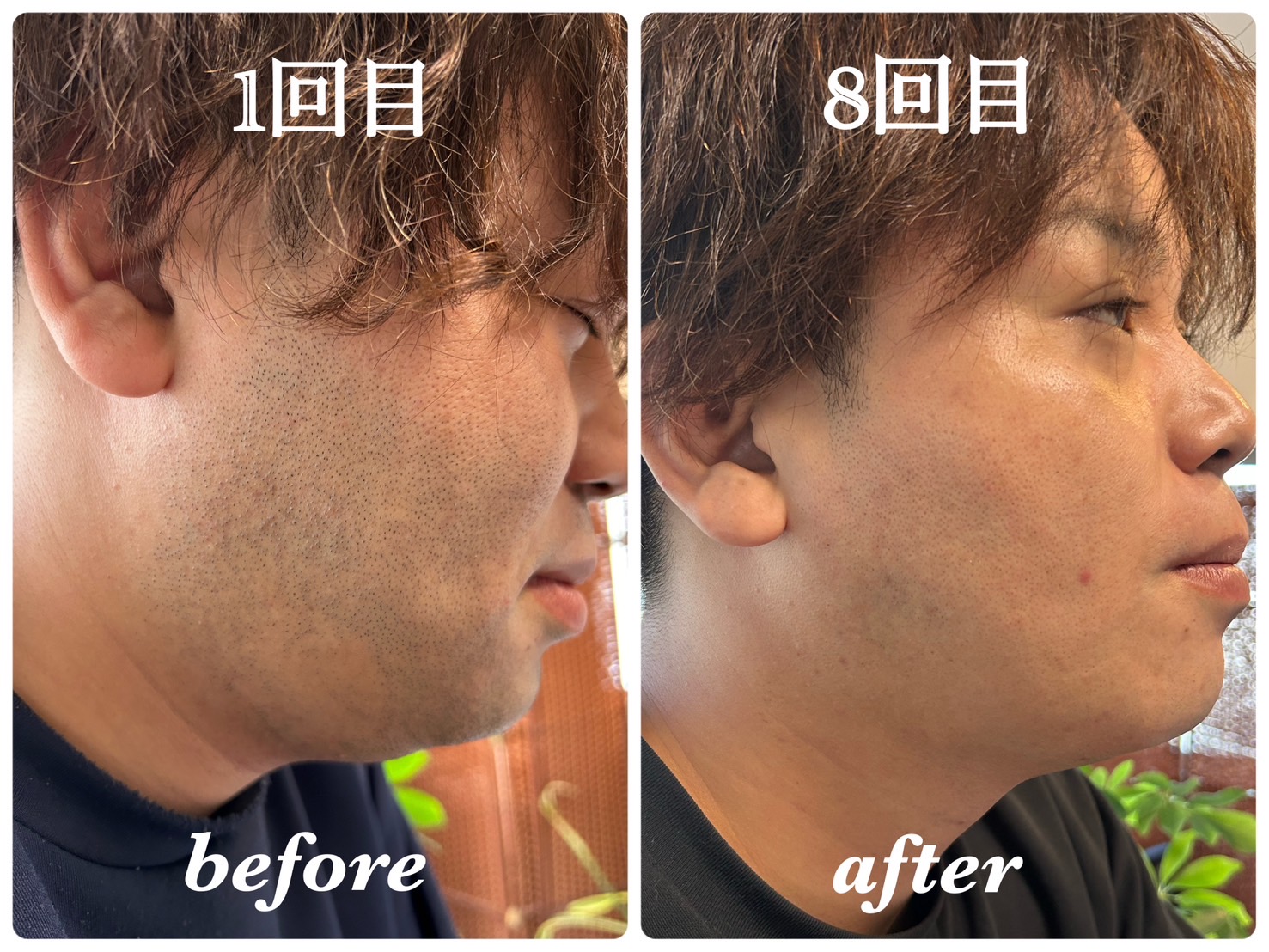 ヒゲ脱毛 1回目→8回目